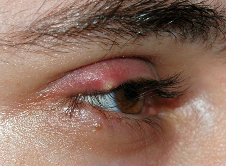 Stye02